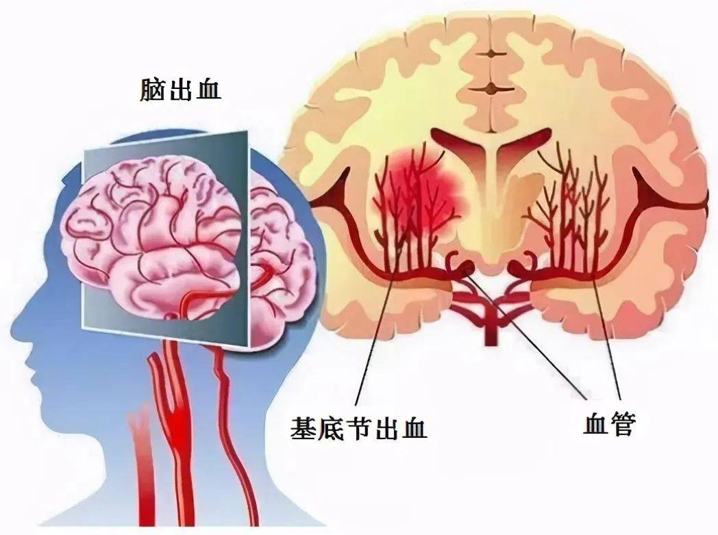 长期熬夜竟成脑出血“导火索”这些身体信号警惕脑出血发生！